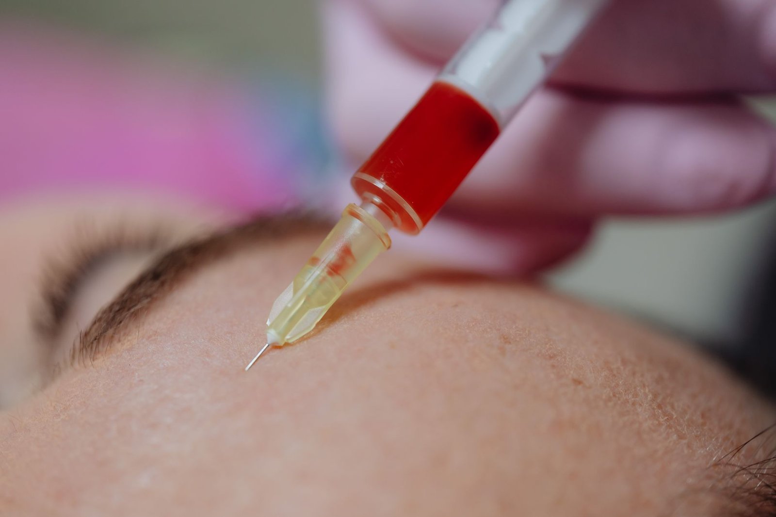 Sıvı Yüz Germe Nedir? Medikal Estetik Uygulamalarında Modern Yaklaşımlar